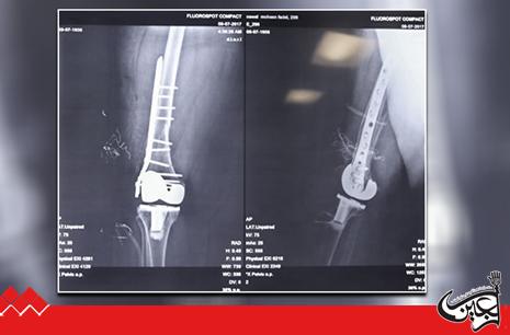 Spiral fracture successfully treated at Zainul Abedeen Hospital.